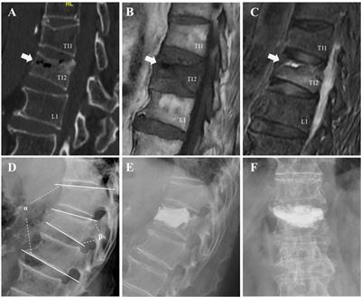 A predictive nomogram for intradiscal cement leakage in percutaneous kyphoplasty for osteoporotic vertebral compression fractures combined with intravertebral cleft